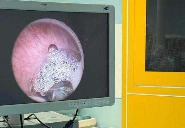 All’Ospedale di Tolmezzo una nuova tecnica laser per la prostata